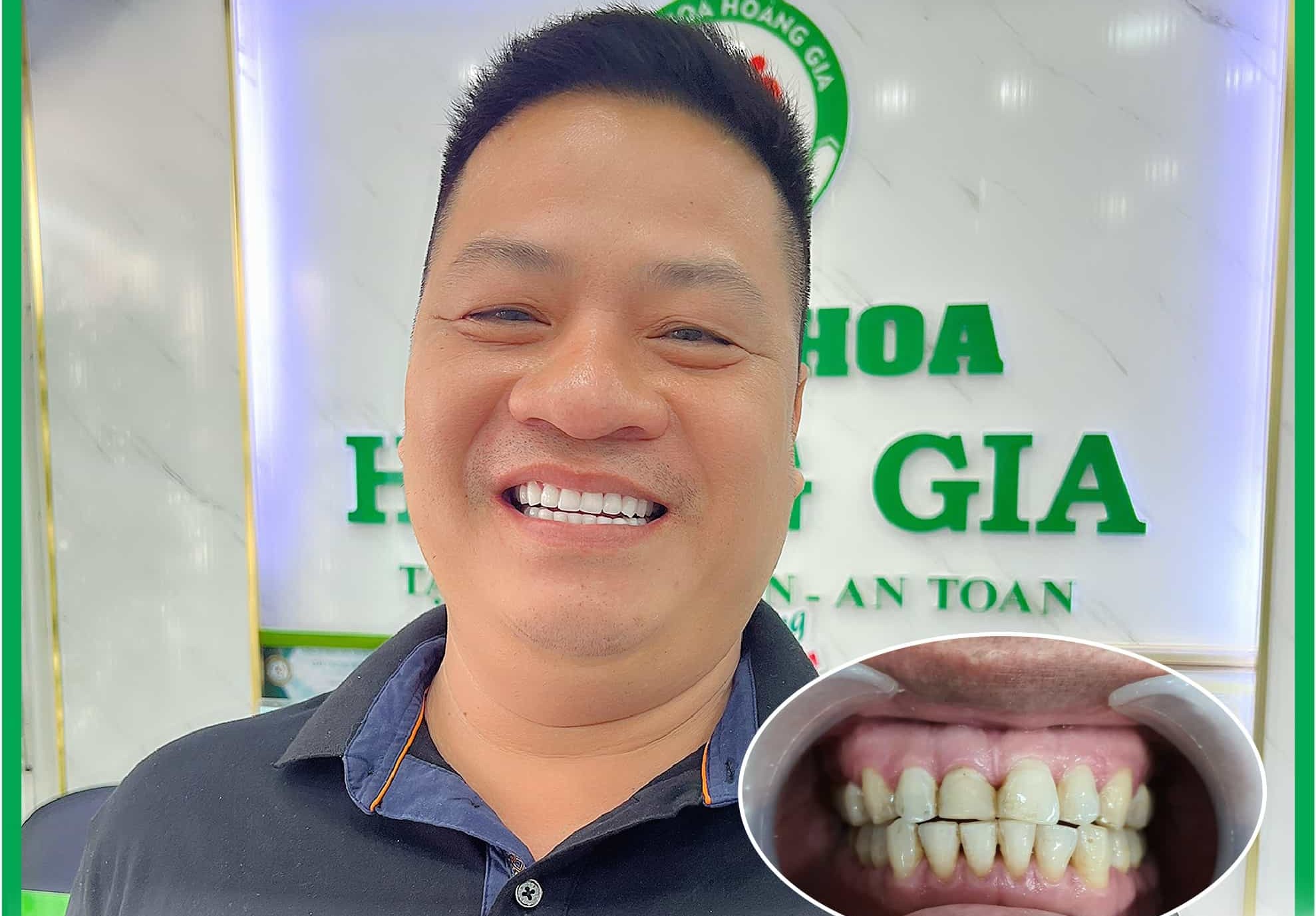 bọc răng sứ Biên Hòa