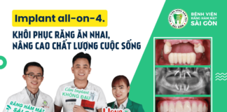 Nhược Điểm Của Trồng Răng Implant